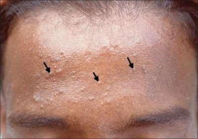 درباره جوش زیر پوستی چه میدانید؟