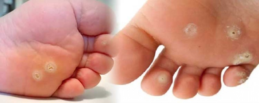 چه زمانی از چسب میخچه استفاده نماییم