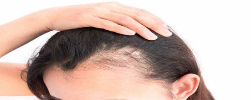 علت ریزش مو در خانم ها