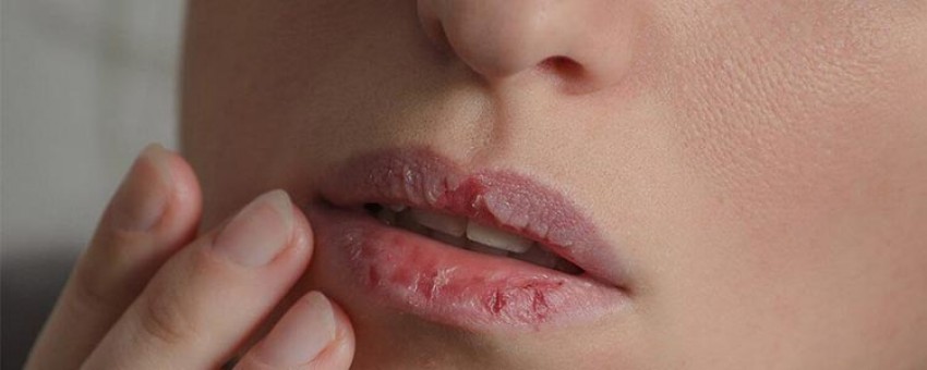 چگونه از شر لبهای ترک خورده خلاص شویم؟