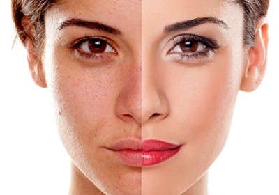 هیدروکینون چیست و چه تاثیری بر روی پوست دارد؟