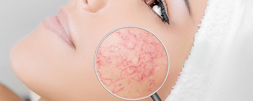 عروق عنکبوتی چیست؟ بررسی علل و بهترین روش درمان