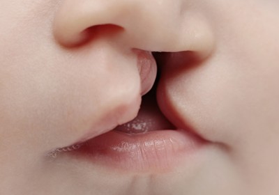 همه چیز درباره شکاف لب و کام؛ درمان و پیشگیری از لب شکری